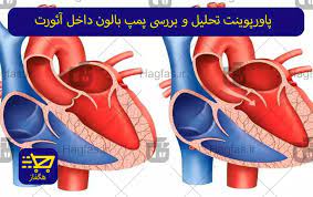 پاورپوینت آشنایی با بالن پمپ داخل آئورت و نحوه کار آن